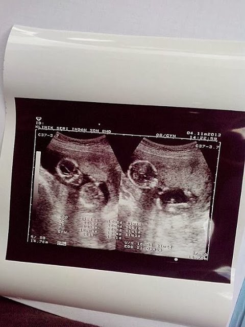 scan-baby-kembar
